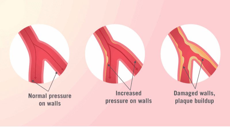 Blood Pressure on artery Walls